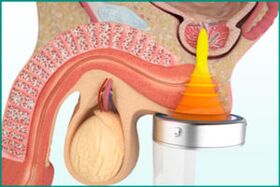 Prostatitic treatment