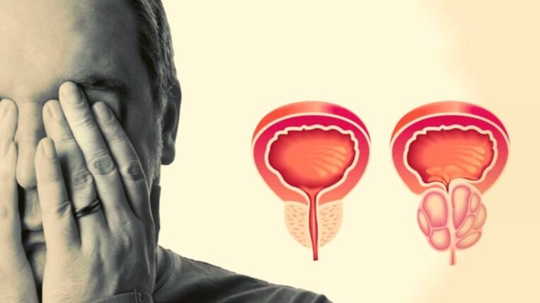 A man has a prostatitis