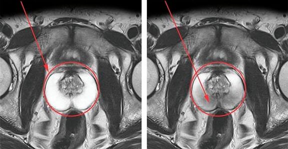 Normal prostate (left) and inflammation of the prostate with prostatitis (right)